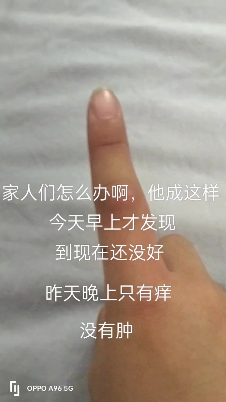 刚涂了酒精,怎么办啊?疼死了截图