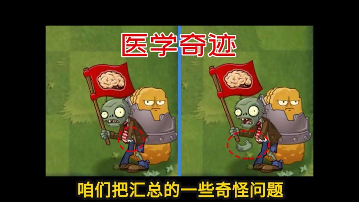 Pvz2流言终结者 断掌重生，堪称医学奇迹！截图